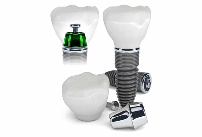 implants