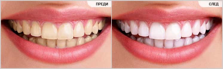 Избелване на зъби (преди-след), D.S.Dent Дентална клиника